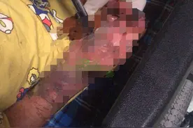 广东七岁男童双手疑被父母烧伤或面临截肢，称因自己“没有做饭”，手上留有被烟头烫伤的痕迹，当地妇联介入图片