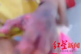 广东7岁男童遭父亲烟头烫伤，男童姑姑：生下第二孩后，弟弟变了图片