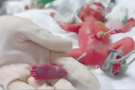 出生仅400克！湖南最轻、全国第二轻的“巴掌宝宝”，用170天创造生命奇迹图片