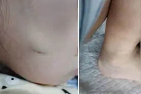 4岁女童遭殴打肠子破裂，生父已被刑拘视频封面