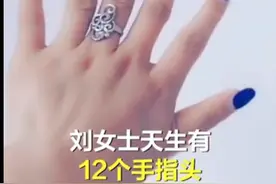 女子天生12根手指，自嘲六指琴魔，网友：毫无违和感图片
