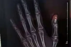 云求助｜吉林李女士称乘坐网约车指甲被车门夹断裂无人管 平台方：已经介入调查图片