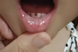 【友谊科普】孩子嘴里长了小白点要小心 可能是“鹅口疮”惹的祸图片