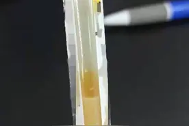 孕妈连续一周每天吃四次高油外卖 血脂超标十倍抽出“牛奶血”图片