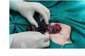 胎儿宫内肠坏死命悬一线，妇幼多学科联合妙手回春图片