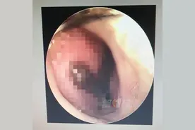 还会动！女子鼻腔取出6厘米水蛭，只因她做了这件事图片