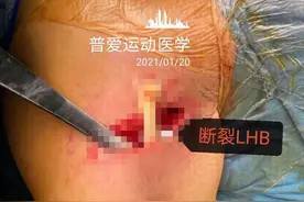 武汉一男子健身后掰手腕，听到“咔”的一声结果悲剧！医生紧急提醒图片