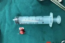 医生跪地手术取出女子误吞假牙图片