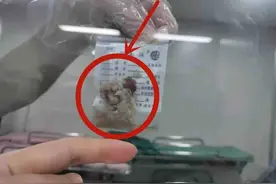 极限生死救援！七旬老人气管卡异物窒息，被成功救治图片