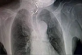 吞鸡爪、吞假牙、吞牙刷……各种千奇百怪的“生吞”姿势，背后是医生一句警告图片