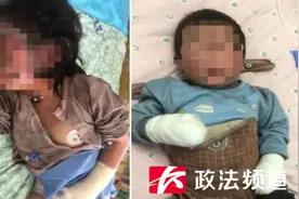 揪心！浏阳小姐弟双双被烧伤，家中这个隐患一定要重视图片