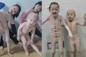 山东妈妈记录烧伤兄妹病房跳舞：用舞蹈预防自闭