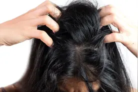 为什么人会长头皮屑？视频封面