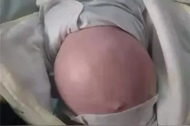 一个月婴儿肚大如皮球！贵州专家“刀尖跳舞”，手术成功图片