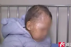 不能晒太阳！湖南3岁男孩患上罕见病，目前无有效药治疗图片