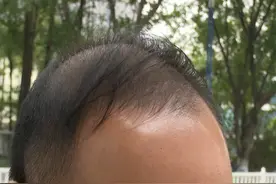 男子理发耳朵被剪掉一块肉，理发店竟拒绝索赔要求：不介意“以肉换肉”图片