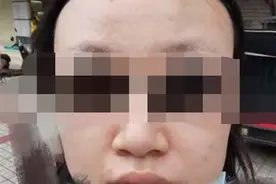 南宁一女子汗蒸护理后脸肿了，养生馆拒绝承担近2000元医疗费图片