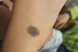 小心，这种“痣”可能是肝癌的信号图片