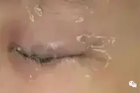 同学浇下一瓶502胶水，12岁男孩右眼皮被粘住了！家长送医院紧急手术...图片