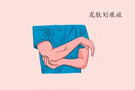 皮肤血管的过敏反应——皮肤划痕症图片