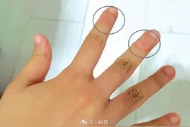 警惕！12岁女孩爱啃手指啃至变形图片