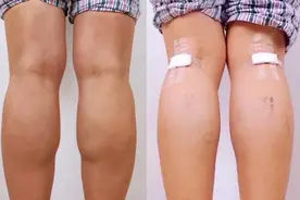 “神经阻断瘦腿”人为制造残疾！七大“医美邪术”谁来管？图片