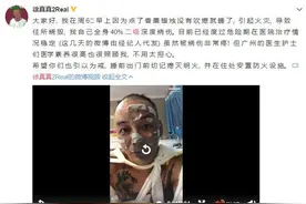 歌手徐真真全身二级深度烧伤 曾与吴亦凡、马东、蔡康永录制节目图片