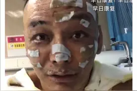 说唱歌手徐真真因没有吹熄香薰蜡烛就入睡，不幸引起火灾，严重烧伤图片