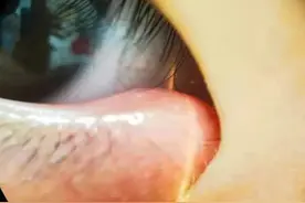 又红又痛！杭州21岁姑娘晚上睡前忘记做这事，一觉醒来长“针眼”！很多人都长过图片