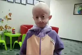 才华横溢的早衰女孩，10岁的年龄，被困在80岁的身体里图片