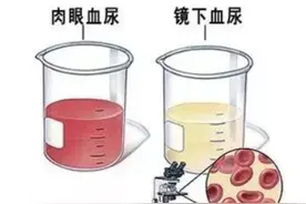 突然“尿血”是怎么回事？警惕泌尿肿瘤图片