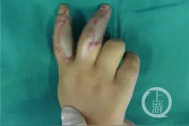 一周内4名儿童连遭跑步机绞伤 8岁女孩手指可见骨头图片