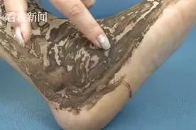 女子半夜回家 一脚踩中毒蛇被咬伤图片