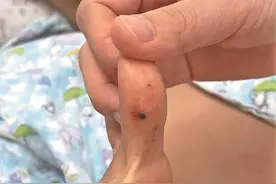 广西一名9岁男童被毒蛇咬伤！担心被责骂未说实情，差点耽误治疗图片