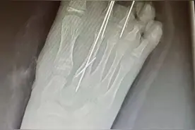 痛！爸爸一个转身，11岁女孩少了两个脚趾图片