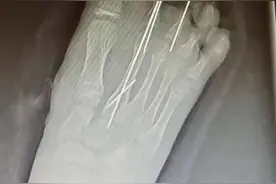 爸爸一个转身，11岁女孩少了两个脚趾！放假1个月，杭州有医院接诊10多例严重创伤小患者图片