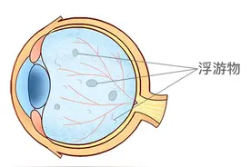 眼前老有蚊子飞，能致盲“飞蚊症”中老年群体必须了解下图片