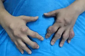 27岁小伙竟有8年痛风病史 烟台山医院为其切除30余处“痛风石”图片