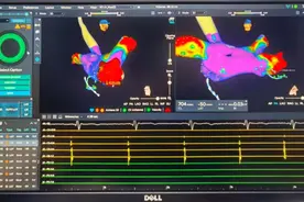 二维变三维，无须接触心内膜就能“隔空”感应 ! 这个手术沪上首例，帮患者告别房颤图片