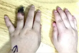 痛心！3岁女童手指坏死只能截除，只因一片创可贴！这个错误千万要小心...图片