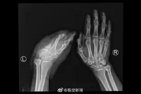 四川运用疫苗冷链技术成功实施断掌再植手术图片