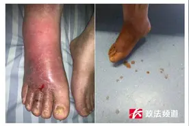 长沙50岁男子足部红肿没重视，结果差点要截肢图片