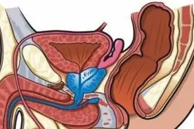 前列腺大了该怎么办——谈谈前列腺增生图片