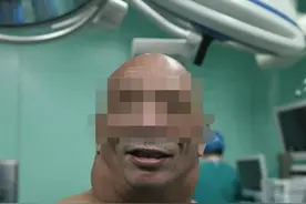当心，喝酒喝出怪病来！“酒王”日饮白酒三两斤，脖子粗得像河马图片