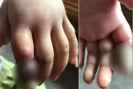 截指警告！3岁女童橡皮筋勒手指6天险截指图片