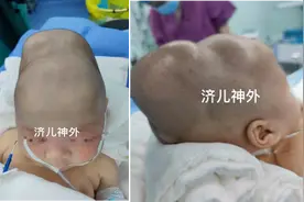 新生儿头上长“犄角”，小心这种病，爸妈必看图片