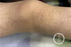 4岁男童连续7个多月反复发烧 竟然确诊“老年病”？图片