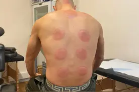 本泽马再晒自己拔罐的照片：有史以来最好的疗法图片