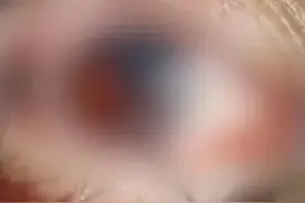 女孩眼球破裂、天花板被打穿！保温杯+红枣枸杞，这个搭配威力竟这么大……图片