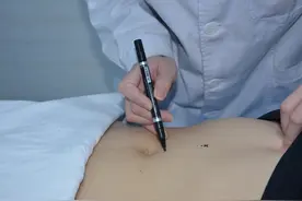 减脂不减水，穴位埋线让你尽情享“瘦”图片